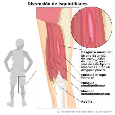 1. Contractura muscular: